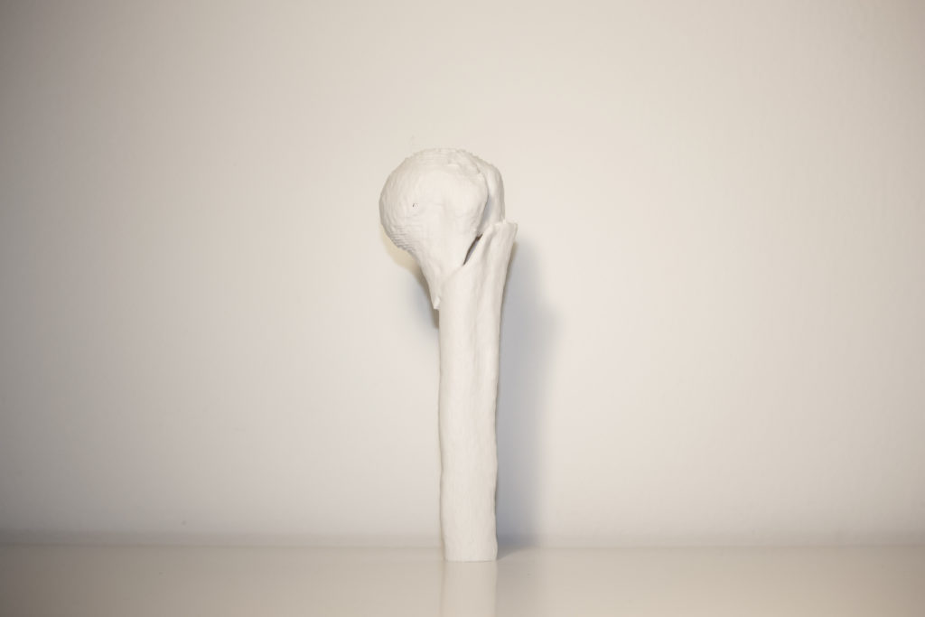 Cattura Schermo1 3DForma resina per stampa 3D chirurgia della mano stecca per dito resina medica liqcreate Scansione TC dell'osso