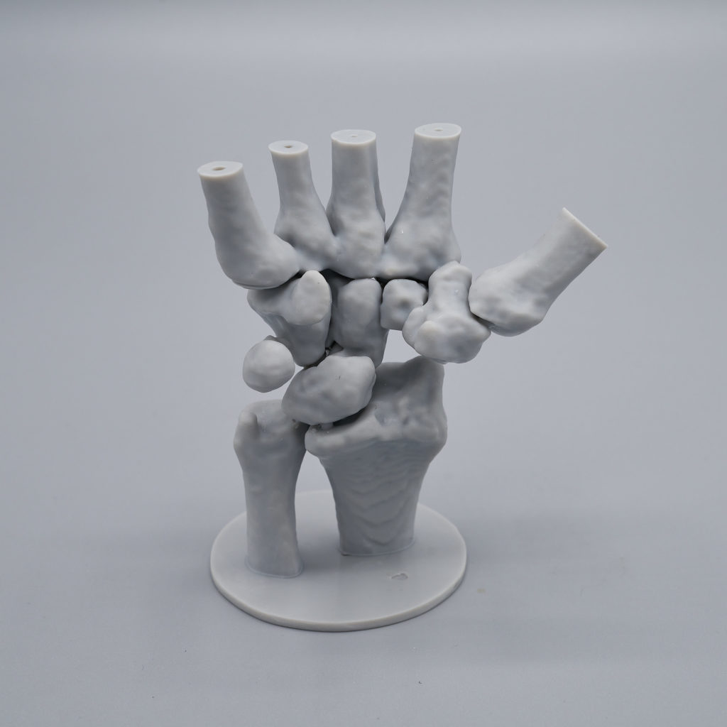 Cattura Schermo1 3DForma resina per stampa 3D chirurgia della mano stecca per dito resina medica liqcreate Scansione TC dell'osso