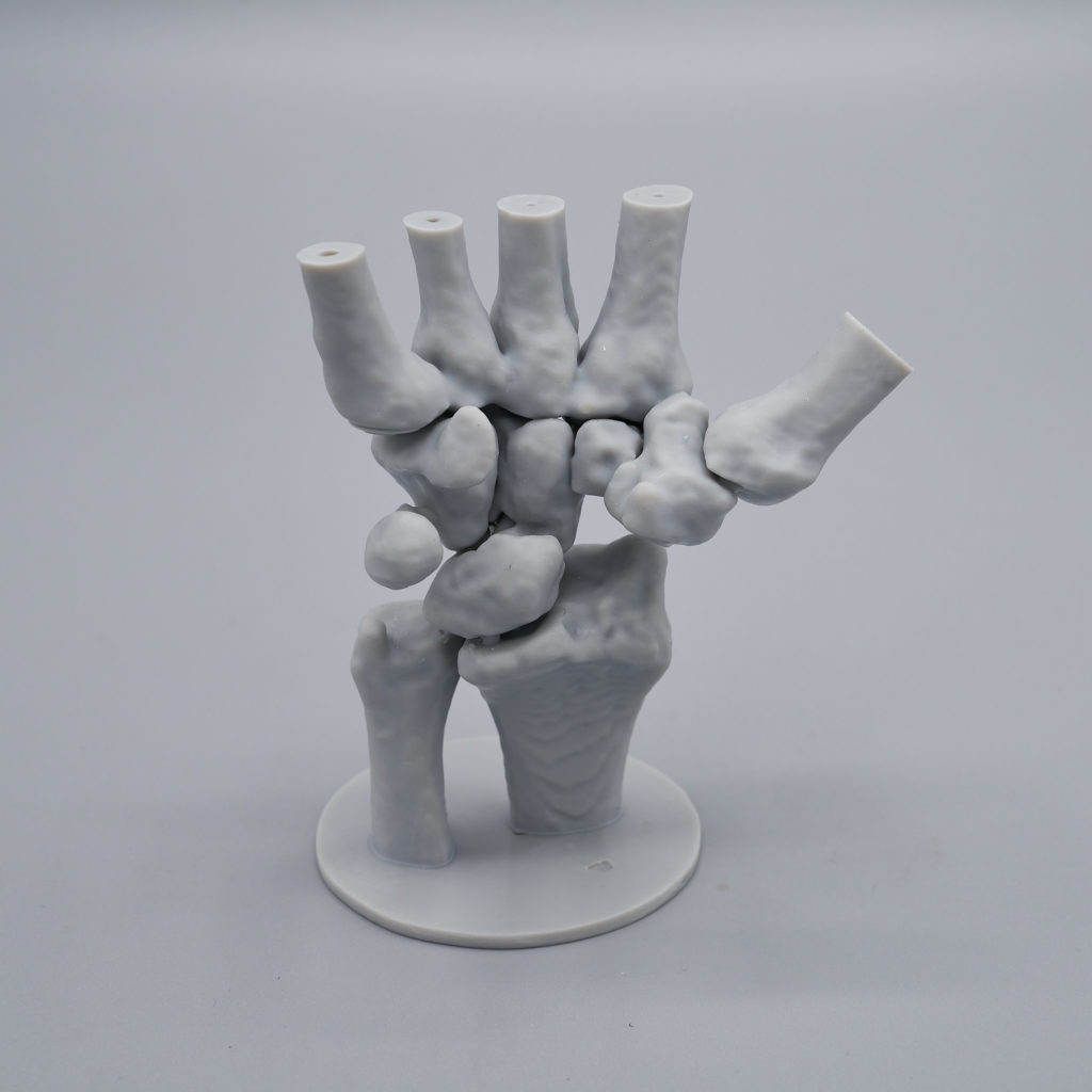 Untitled Capture9868 Cattura Schermo1 3DForma 3D-printing resin hand surgery finger splint medical resin liqcreate CT scan bone